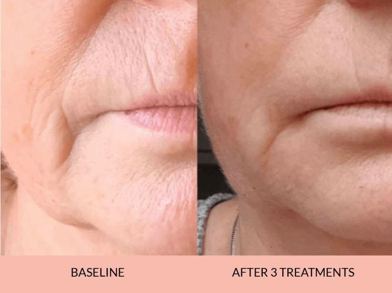 Before_after-01_-768x575-1