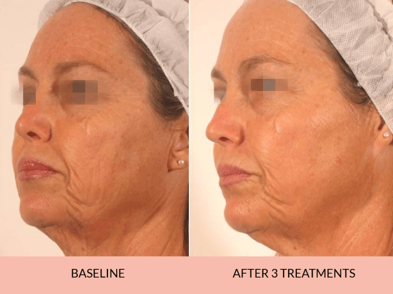 Before_after-04_-768x575-1