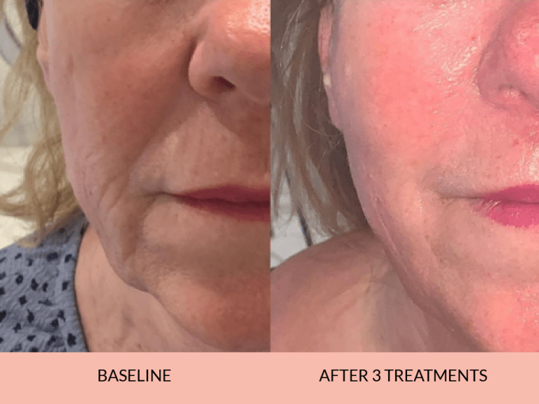 Before_after-10_-768x575-1